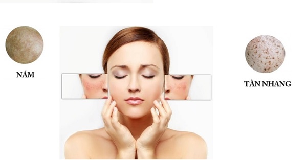 dau-hieu-nhan-biet-tan-nhang-1 Những dấu hiệu nhận biết tàn nhang