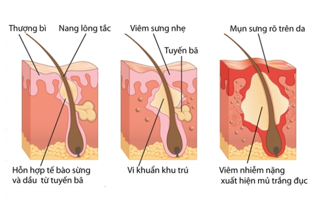 giai-doan-tien-trien-cua-mun-boc Các giai đoạn tiến triển của mụn bọc