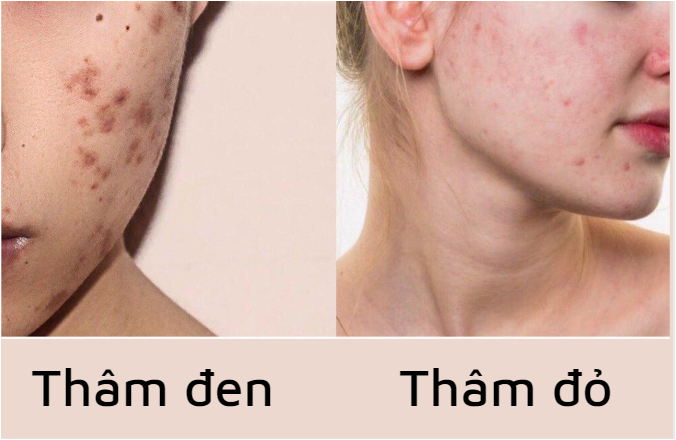 hinh-anh-tham-mun Hình ảnh thâm đỏ và thâm đen sau mụn