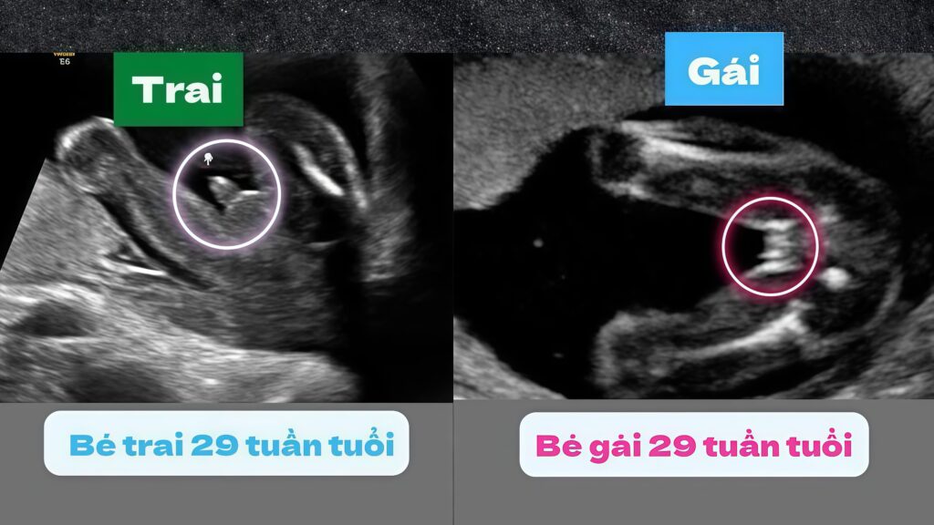 Hình ảnh túi thai con trai và hình ảnh túi thai con gái