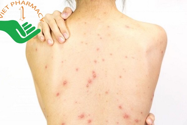 mun-trung-ca-o-lung-1 Mụn trứng cá ở lưng