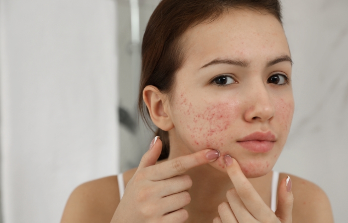 nan-mun-xong-nen-lam-gi-cach-cham-soc-da-sau-khi-nan-mun Nặn mụn giúp da thông thoáng nhưng cũng cần biết cách chăm sóc da đúng cách sau khi nặn
