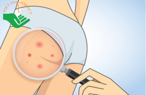 nguyen-nhan-gay-mun-boc-o-mong Có nhiều nguyên nhân gây mụn bọc ở mông