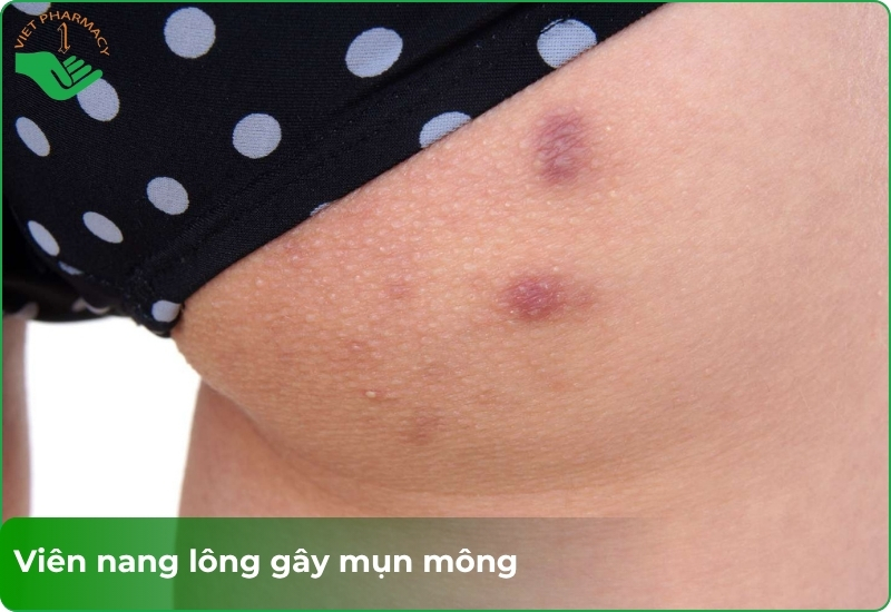 Mụn mông do bị viêm nang lông