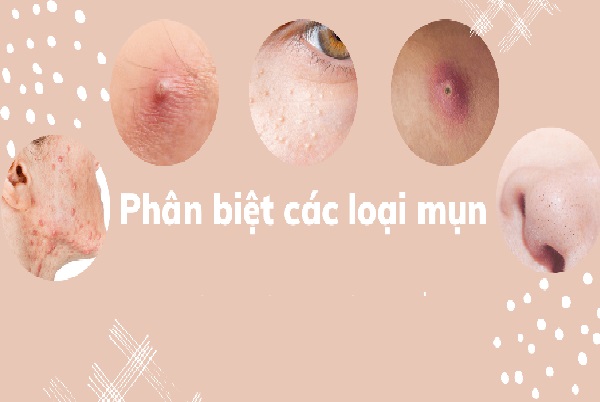 Phân biệt các loại mụn