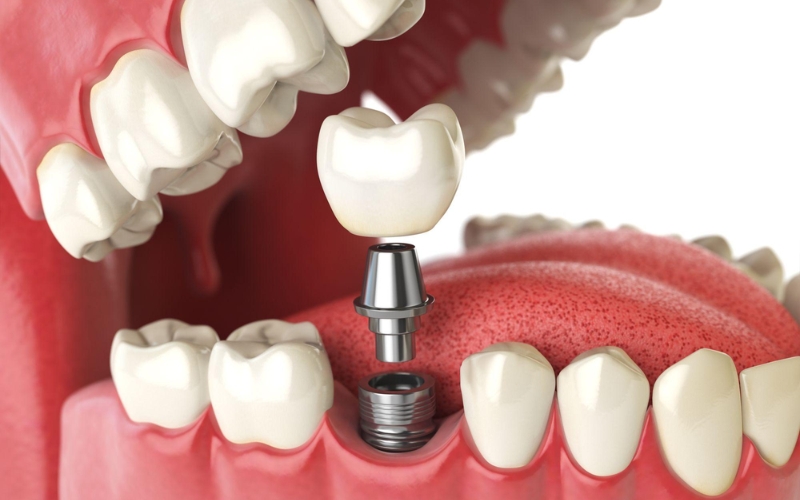 Implant dễ tác động đến những răng nằm kế, trám răng inlay onlay hỗ trợ phân tán lực đều khi ăn nhai