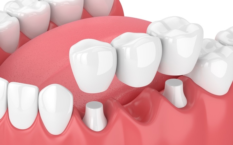 Cầu răng sứ kết hợp cùng trám răng inlay onlay giúp răng trụ khỏe hơn và tăng tuổi thọ