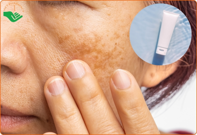 Cách chọn kem trị nám tốt nhất cho làn da