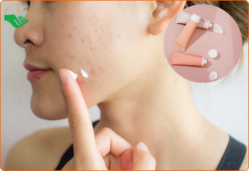 Kinh nghiệm chọn kem trị mụn của Nhật Bản