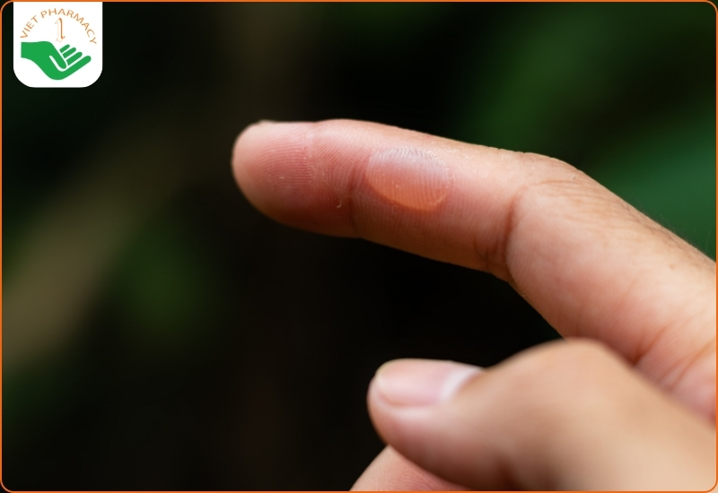 Trường hợp nào nên khám bác sĩ khi da bị nổi mụn nước ngứa?