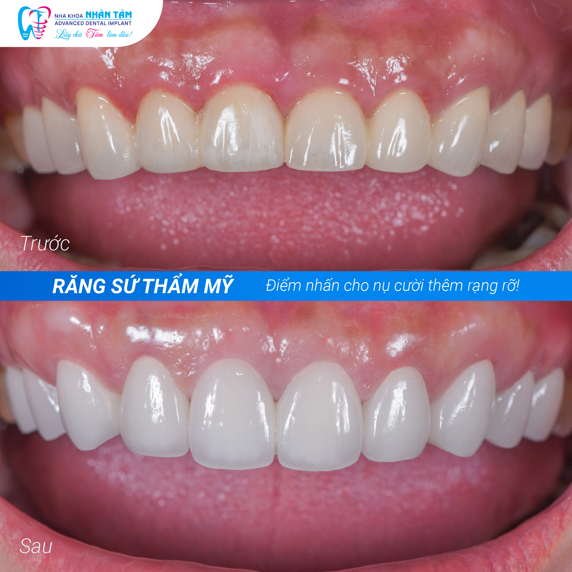 Khách hàng sau khi thẩm mỹ răng sứ tại nha khoa Nhân Tâm (Ảnh: Fanpage Nhân Tâm)