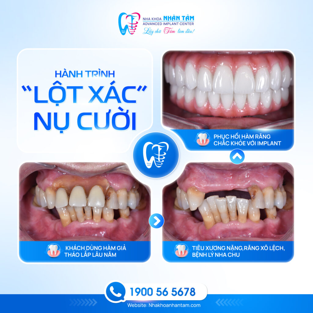 Khách hàng thực hiện trồng răng Implant tại nha khoa Nhân Tâm (Ảnh: Fanpage Nhân Tâm)