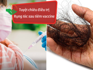 Tuyet chieu dieu tri rung toc sau tiem vaccine