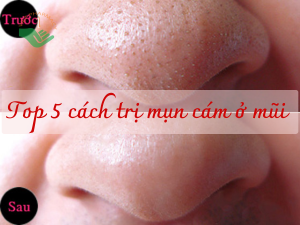 Top 5 cách trị mụn cám ở mũi tại nhà đơn giản mà siêu hiệu quả