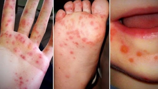 Bé bị tay chân miệng sẽ có những nốt bóng nước xuất hiện ở miệng, lòng bàn tay, bàn chân