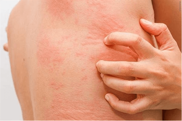 Bị dị ứng ngứa khắp người phải làm sao?