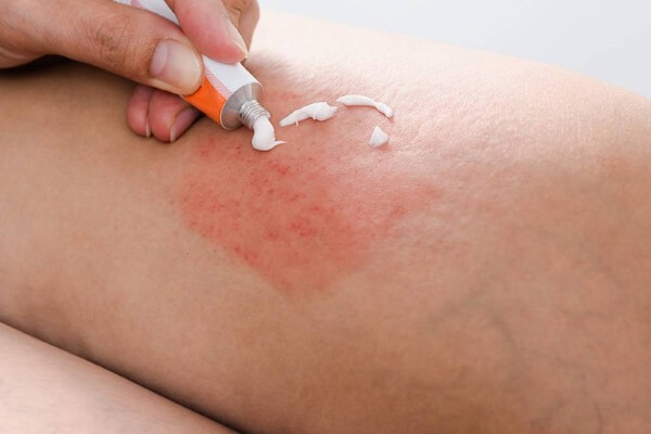 Dùng kem dưỡng ẩm bôi lên vùng da bị dị ứng để giảm triệu chứng ngứa
