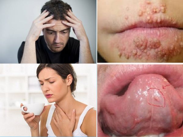 Biến chứng khi mắc sùi mào gà ở lưỡi, miệng