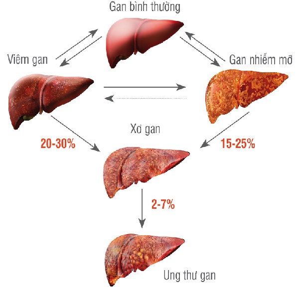 Biến chứng nguy hiểm của gan nhiễm mỡ