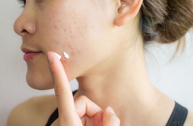 Bôi kem trị mụn để điều trị mụn trứng cá viêm
