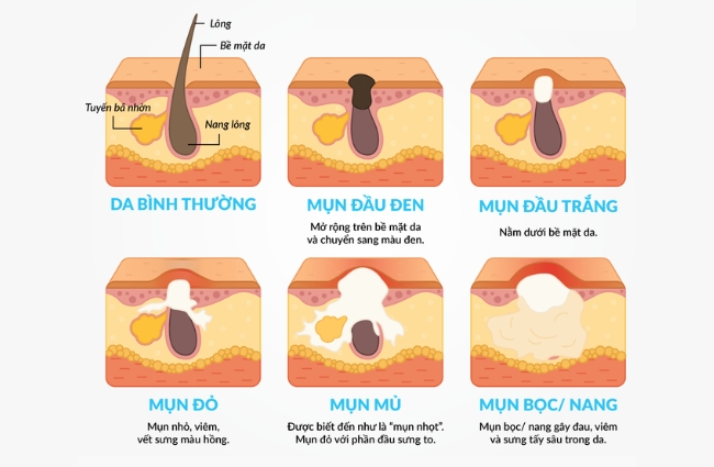 Các loại mụn trứng cá thường gặp