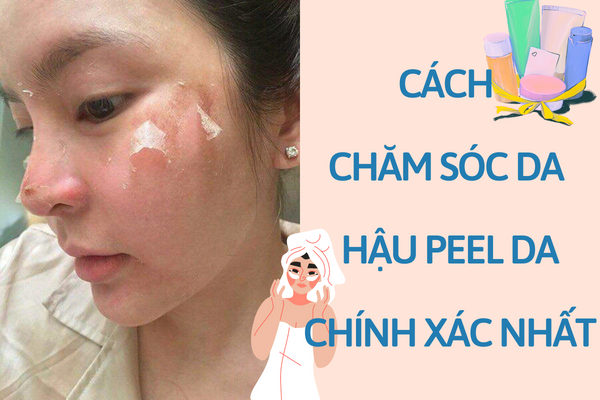 Cách chăm sóc da sau khi peel đúng nhất