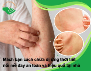 cach-chua-di-ung-thoi-tiet-noi-me-day-thumb