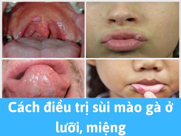 Cách điều trị sùi mào gà ở lưỡi, miệng