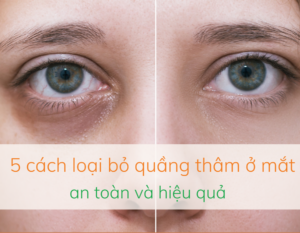 cach-loai-bo-quang-tham-o-mat-an-toan-va-hieu-qua-1