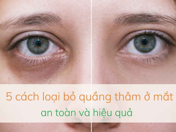 5 Cách loại bỏ quầng thâm ở mắt