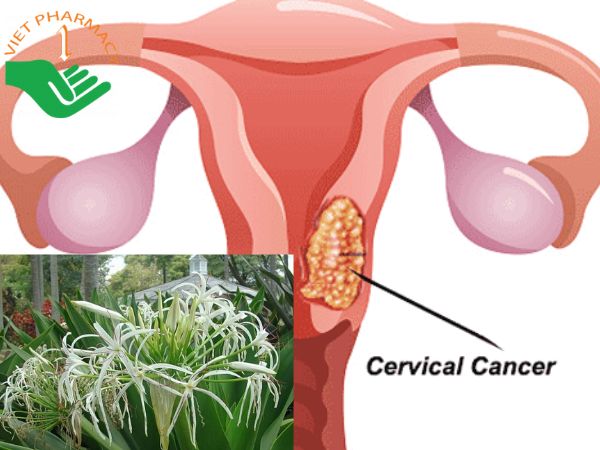 Uống nước lá trinh nữ hoàng cung tươi hỗ trợ điều trị ung thư cổ tử cung