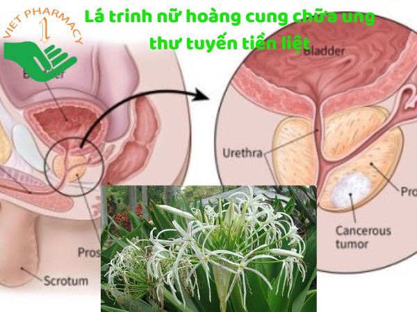 U xơ tuyến tiền liệt có thể điều trị bằng cách uống nước lá trinh nữ hoàng cung