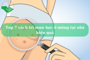 cach-tri-mun-boc-o-mong-tai-nha-hieu-qua
