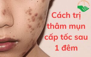 cach-tri-mun-cap-toc-sau-1-dem