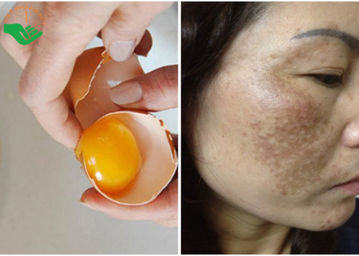 Lòng đỏ trứng hỗ trợ phục hồi các tổn thương do nám gây ra