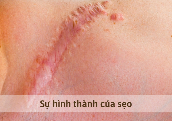 Sẹo là kết quả do quá trình tự lành vết thương của các tế bào da