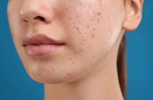 Mụn thâm rất lâu khỏi và gây mất thẩm mỹ cho làn da