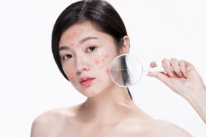 collagen-co-tac-dung-tri-mun-khong