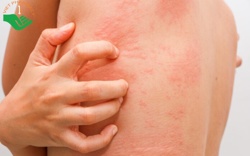 Triệu chứng da bị dị ứng ngứa phải làm sao?