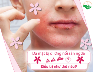da-mat-bi-di-ung-noi-san-ngua-la-do-dau-dieu-tri-nhu-the-nao-3