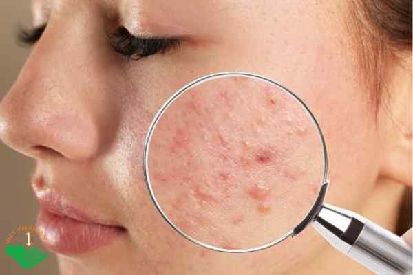 Da mụn ẩn - nỗi ám ảnh của nhiều người hiện nay