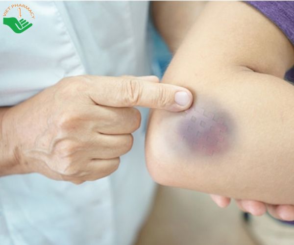Các vết bầm tím trên cơ thể lâu tan
