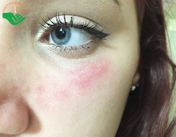 Dấu hiệu dị ứng mỹ phẩm nhẹ trên da mặt
