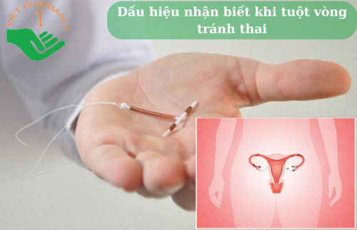 DẤU HIỆU VÒNG TRÁNH THAI BỊ LỆCH