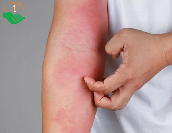 Biểu hiện của viêm da tiếp xúc dị ứng