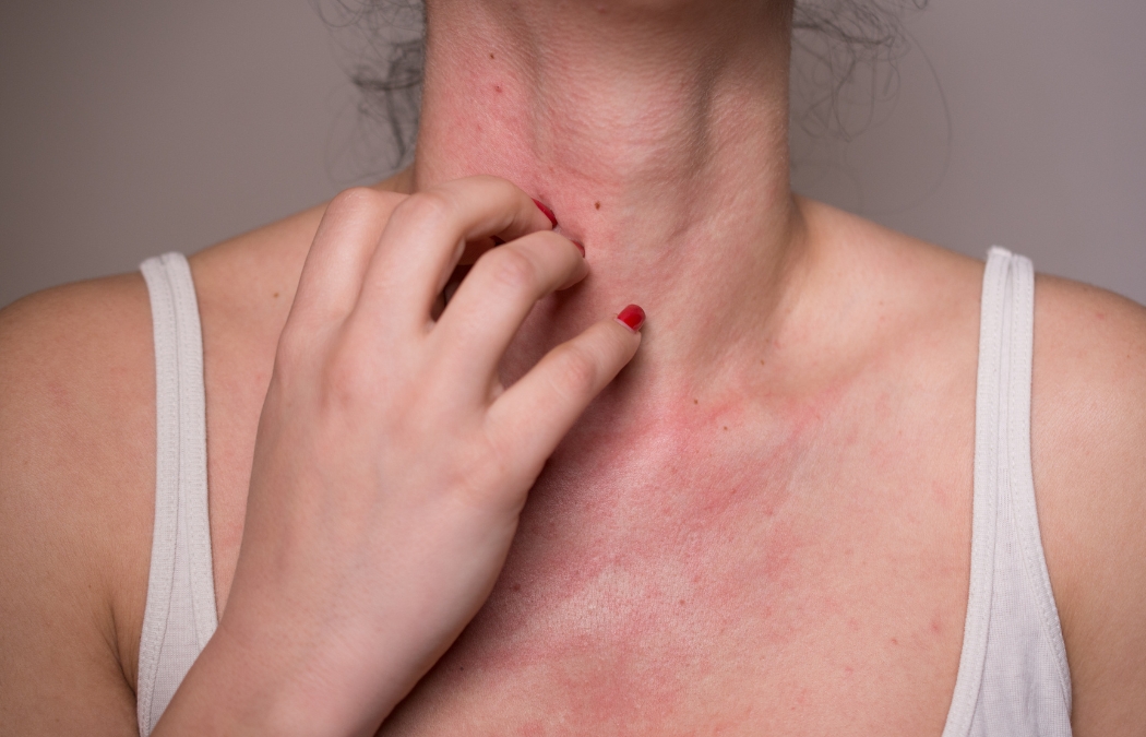 Dị ứng đã được báo cáo khi dùng Enterogermina