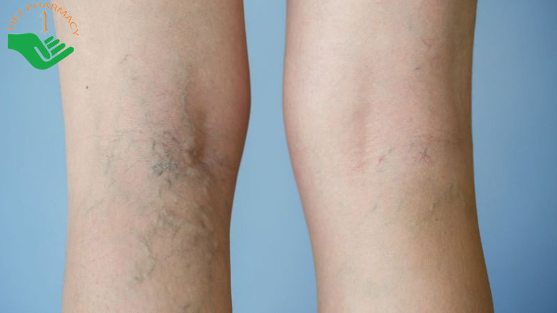 Giãn tĩnh mạch ở bà bầu 3 tháng giữa