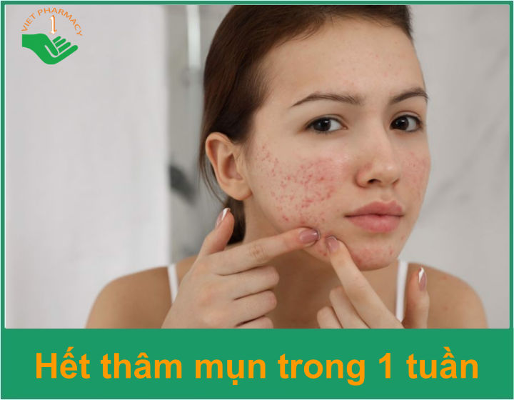 TRỊ THÂM MỤN CẤP TỐC CHỈ SAU MỘT ĐÊM HIỆU QUẢ RÕ RỆT