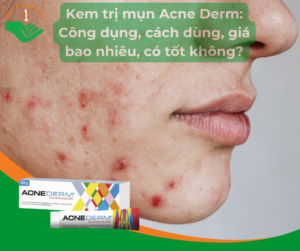 kem-tri-mun-acne-derm-cong-dung-cach-dung-gia-bao-nhieu-co-tot-khong
