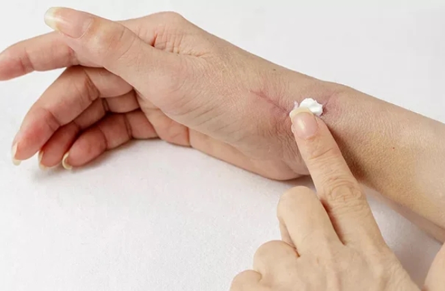 Sử dụng kem trị sẹo đúng cách để đem lại hiệu quả cao